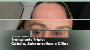 Transplante Capilar - Dra Thalita Carlesso