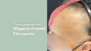 Transplante Capilar - Dra Thalita Carlesso